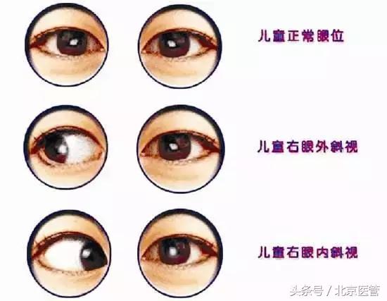 7岁儿童老是揉眼睛眨眼怎么回事,孩子眼睛斜视的最佳治疗方法