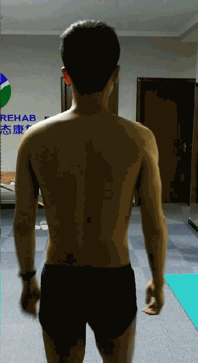 线下矫正案例分析｜体态与步态的关系，粗细腿大小臀是怎么出现的