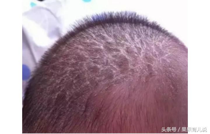 宝宝头上的头垢如何处理？