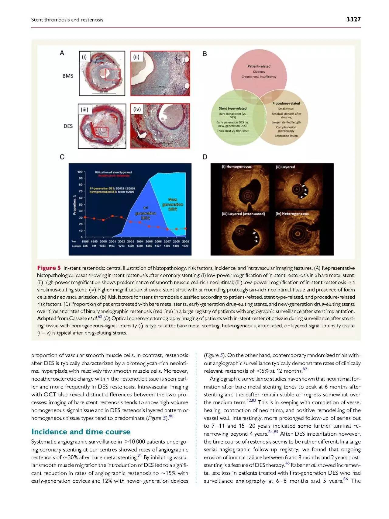 支架内血栓怎么处理,支架内血栓的原因及表现