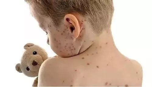 辽宁省疾控发布重要提醒：这种自费疫苗不仅要打，还得打两次！