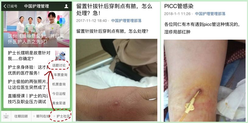 穿刺导致血液细菌感染怎么办,输液港穿刺点感染的原因