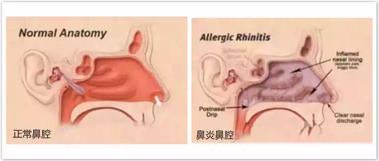 鼻塞、呼吸不畅，教你简单一招，瞬间通鼻窍！只要一点“水”~
