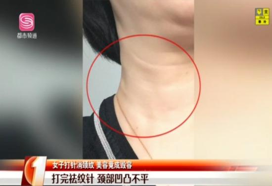 打祛颈纹针有什么后遗症,深圳女子瘦脸针