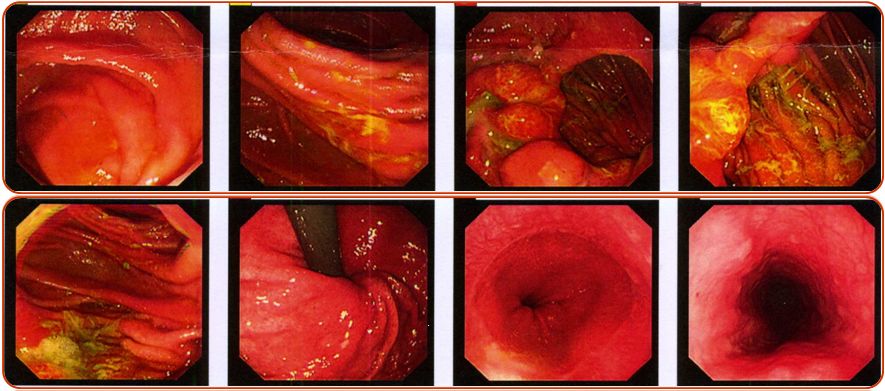同为腹水，命运迥异