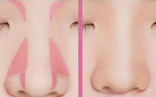 鼻子很矮不动手术怎么改善,怎么修鼻子立体不塌鼻