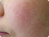 血丝病最佳治疗方法,血丝怎么形成的