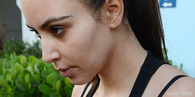 睡眠不足怎么消除黑眼圈,睡眠不足造成的黑眼圈怎么消除