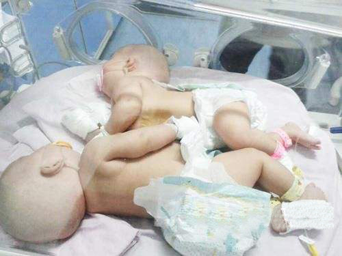 双胞胎畸形连体真实案例,胎儿连体可能由什么导致