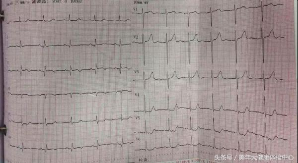 病例分享:服用华法林的月经期女性发生急性心肌梗死1例