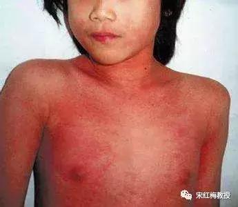 猩红热要注意什么,猩红热一般是怎么得的