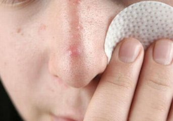 你知道什么叫痘印吗,成人痘是什么意思