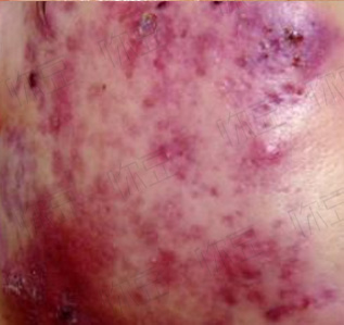 班赛祛痘吗,用班赛会爆痘吗