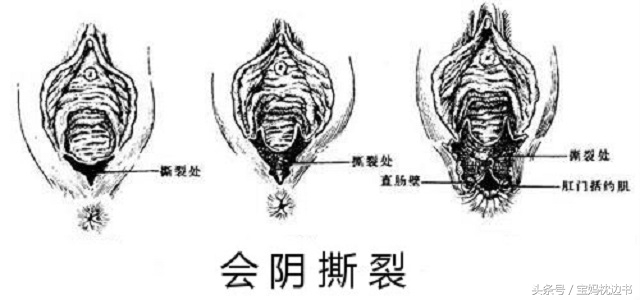 顺产要侧切还是顺切,侧切和不侧切无撕裂有什么区别
