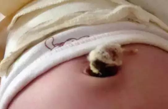 新生儿肚脐5个异常要注意！这篇宝宝脐部护理攻略送给月嫂！