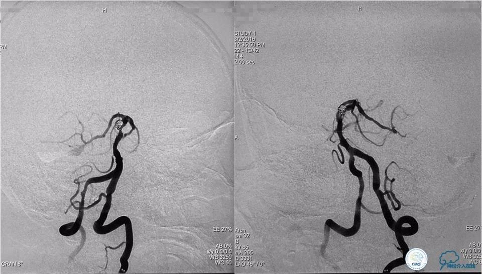 脑动脉瘤并颈动脉狭窄怎么治疗,脑动脉血管狭窄介入治疗效果好吗