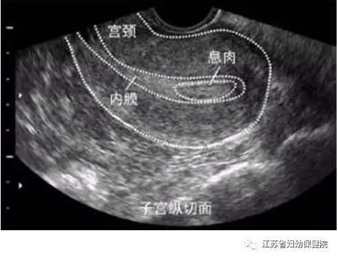 子宫内膜息肉的医学解释,子宫息肉的有关科普