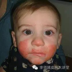 「杏林微科普」冻疮攻防攻略