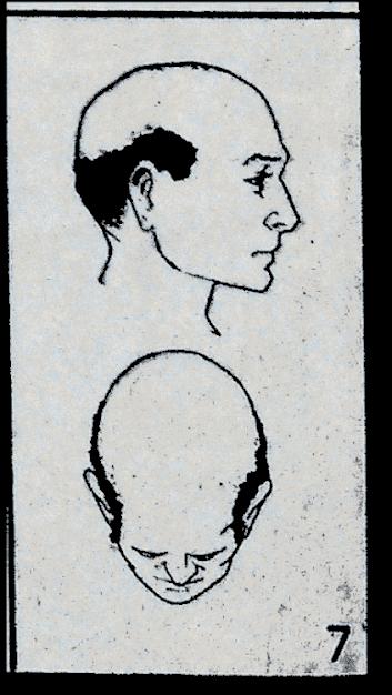 8090后秃头,80后有多少人秃头了