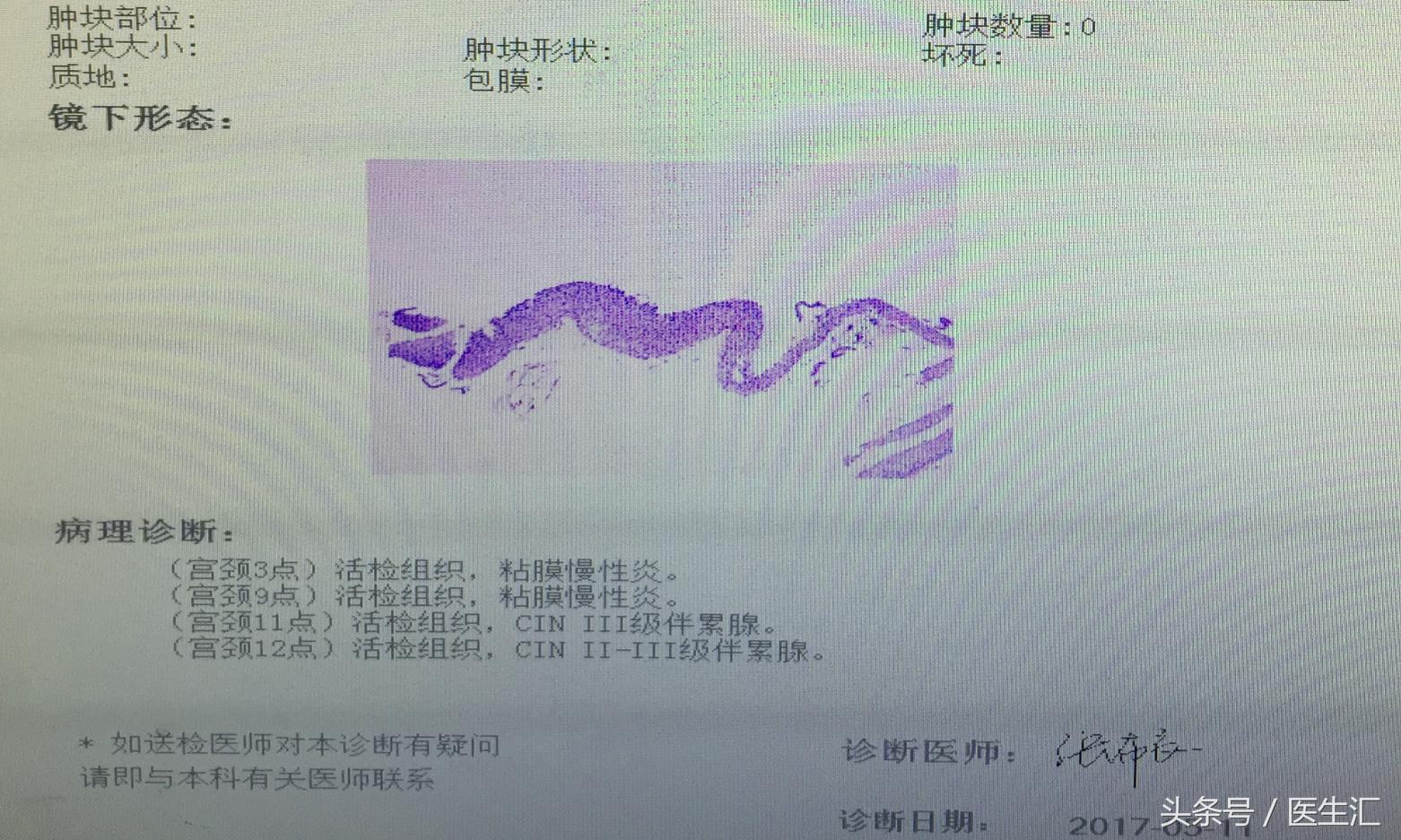 月经量多、阴道出血！小心子宫腺肌症！