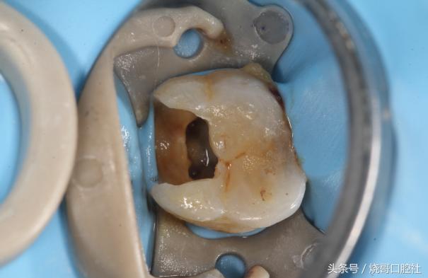 补牙一年多了咬东西还疼,补牙一年了咬合有点酸