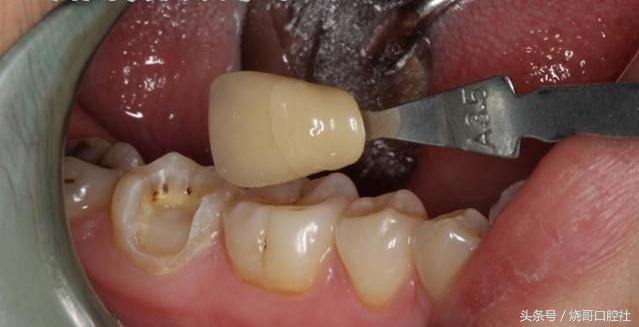 戴牙冠哪种材料便宜对人体无害,种植牙后牙冠用什么材料好