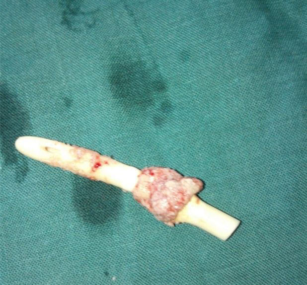 插三个月尿管拔了排尿的最快方法,拔完尿管出现小便不受控制怎么办