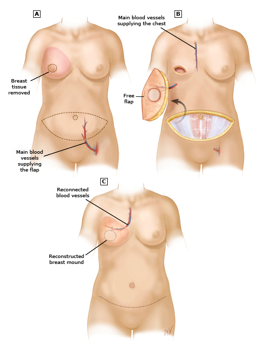 乳房全切和乳房重建能同时手术吗,乳房重建切口