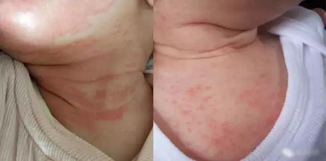 崔玉涛医生谈湿疹,婴儿湿疹和热疹的区别崔玉涛