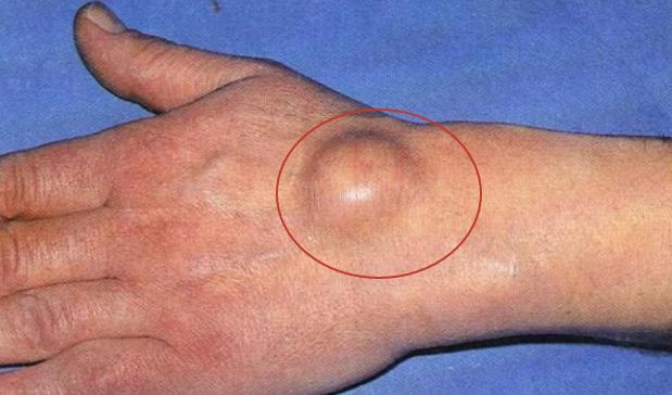 手腕上长了这种奇怪的鼓包，是肿瘤么？