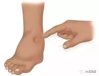 水肿肾炎患者的饮食和注意事项,简述肾病水肿的护理