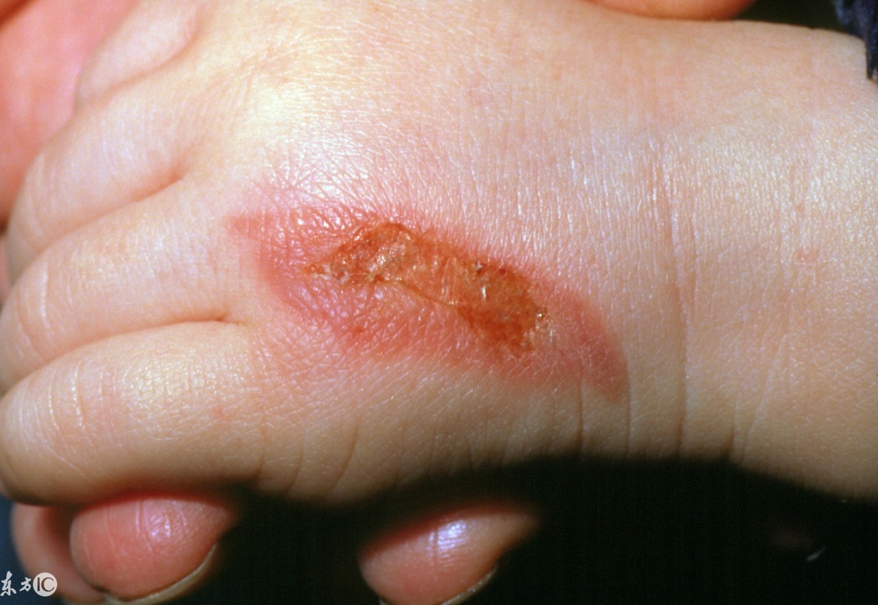 大人被开水烫伤怎么处理好得快,烫伤后可以涂牙膏蜂蜜酱油吗