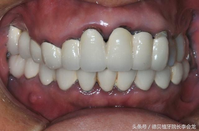 烤瓷牙表面掉瓷了对人身体有害吗,钴铬合金烤瓷牙对身体有害吗