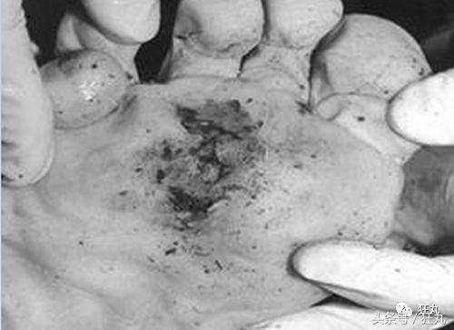 被闪电击中的人会怎么样,被闪电击中得到永生