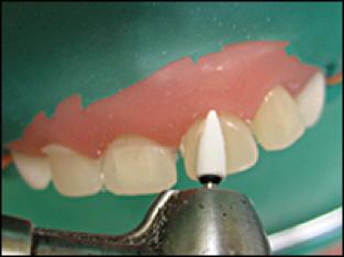 前牙光固化美容修复的方法,乳前牙预成冠修复过程