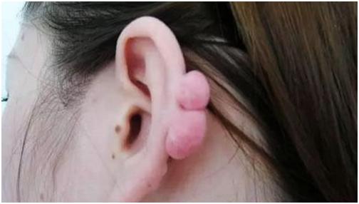 学人赶时髦打耳孔，谁知道耳朵上竟然长了个这玩意