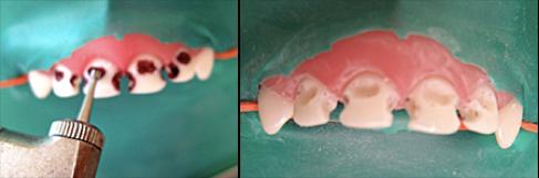 乳前牙预成冠补牙过程,乳前牙龋坏修复