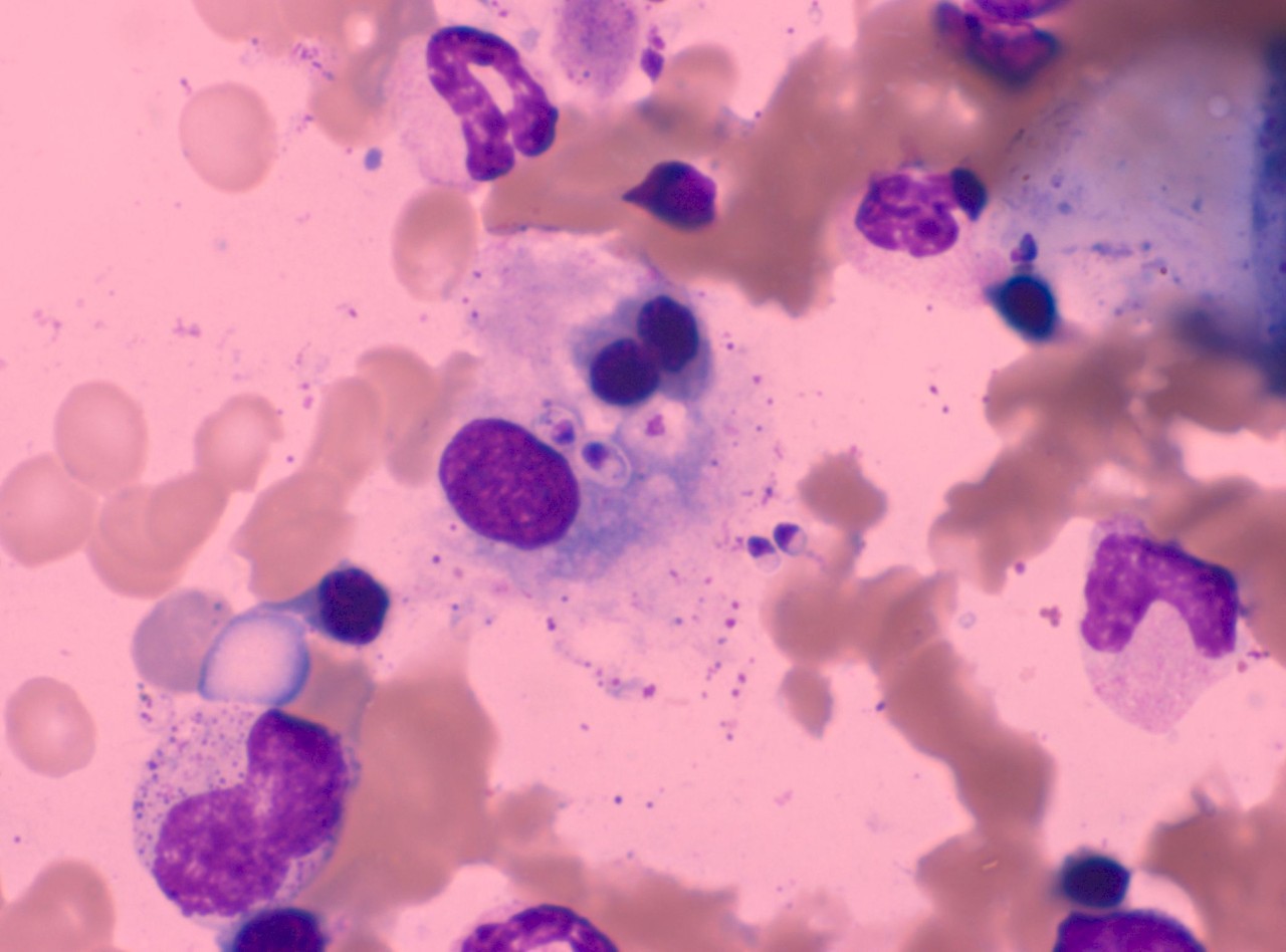 胞浆内颗粒减少,胞浆内颗粒增多