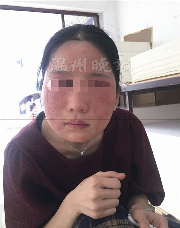 护肤品使用后脸部溃烂苍南美少女美容变毁容