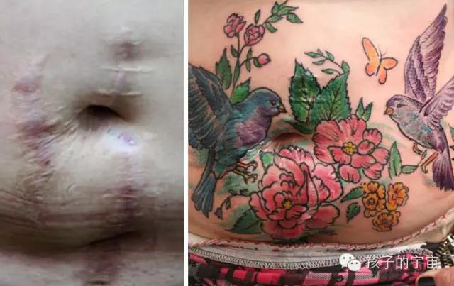 当剖腹产的伤口上开出了花！好美