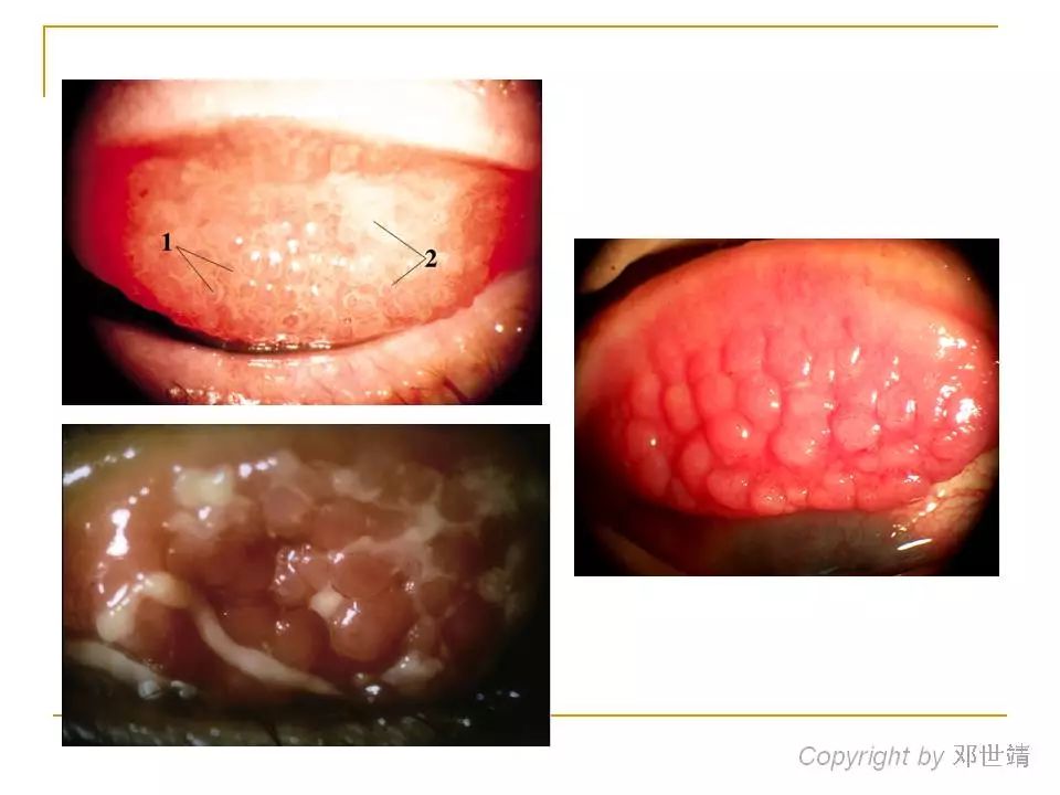 眼周过敏中医治疗,眼周过敏的症状图片