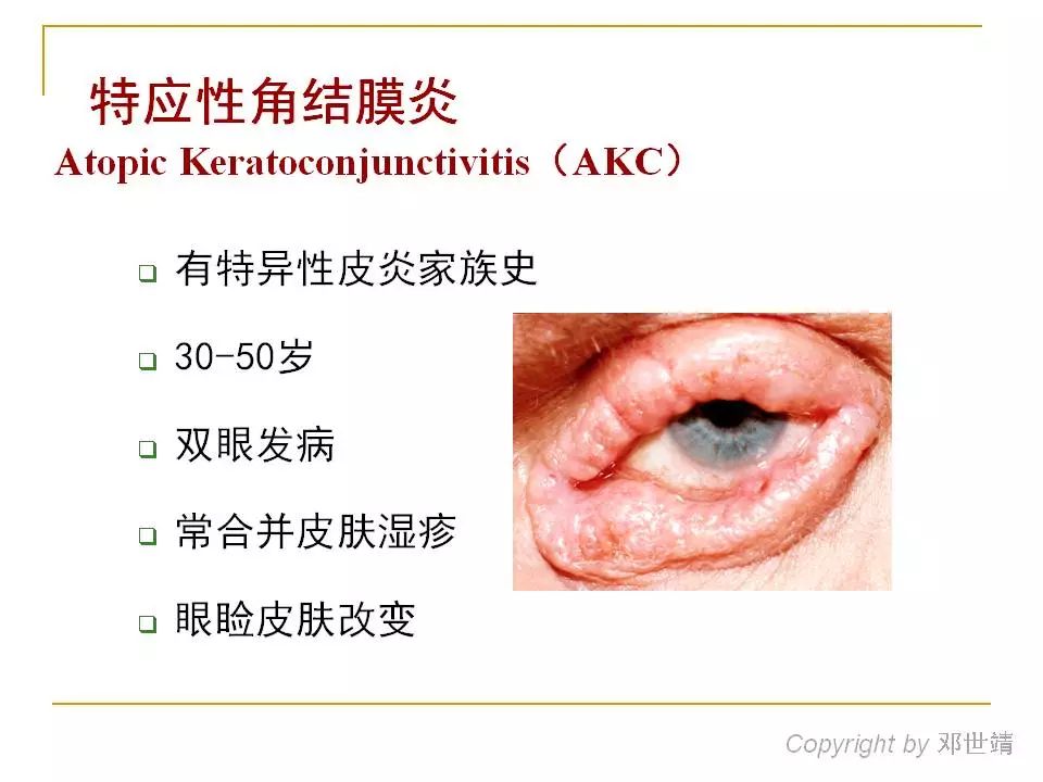 眼周过敏中医治疗,眼周过敏的症状图片