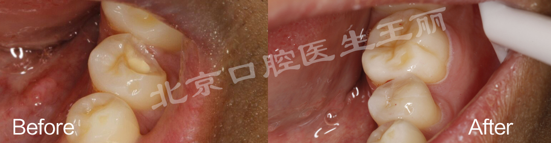 北京口腔医院修复科王淑英,补牙全冠和嵌体的哪个好