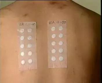 宝宝湿疹需要忌口鱼吗,过敏湿疹十大忌口水果