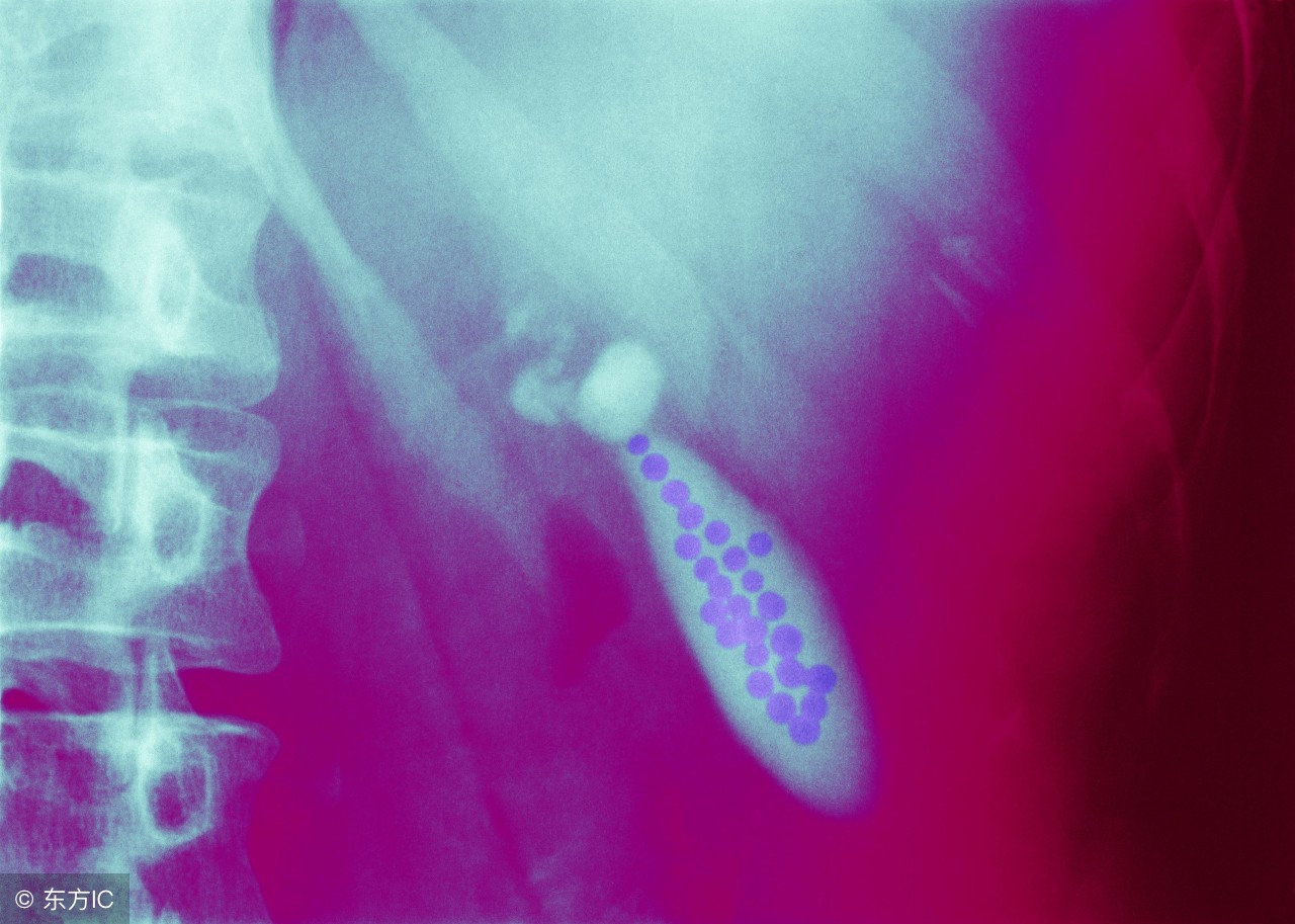 肝内胆管结石术后一般几年复发,胆管结石用ercp取石几次又复发