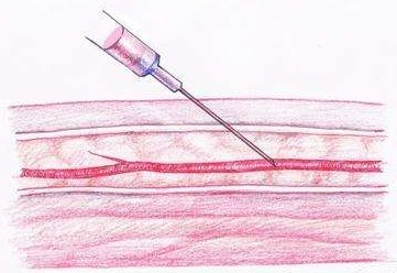 抽完血之后胳膊细了一圈,抽了血手臂发紫一个礼拜了