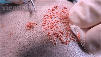 日本研究秃顶,日本教授秃头研究