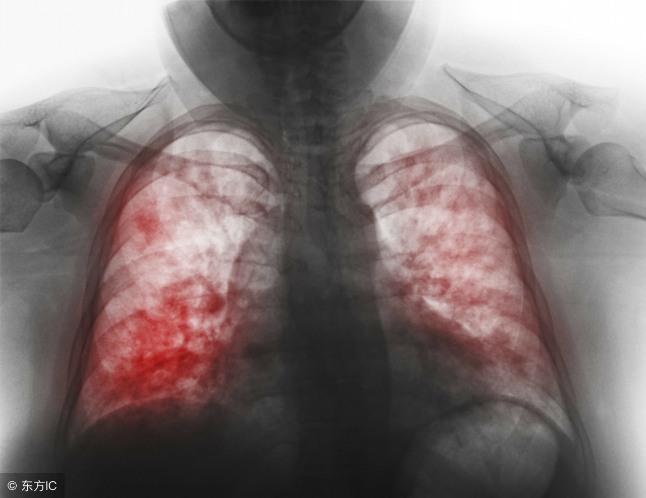 重症流感的症状,重症流感应采取几级防护