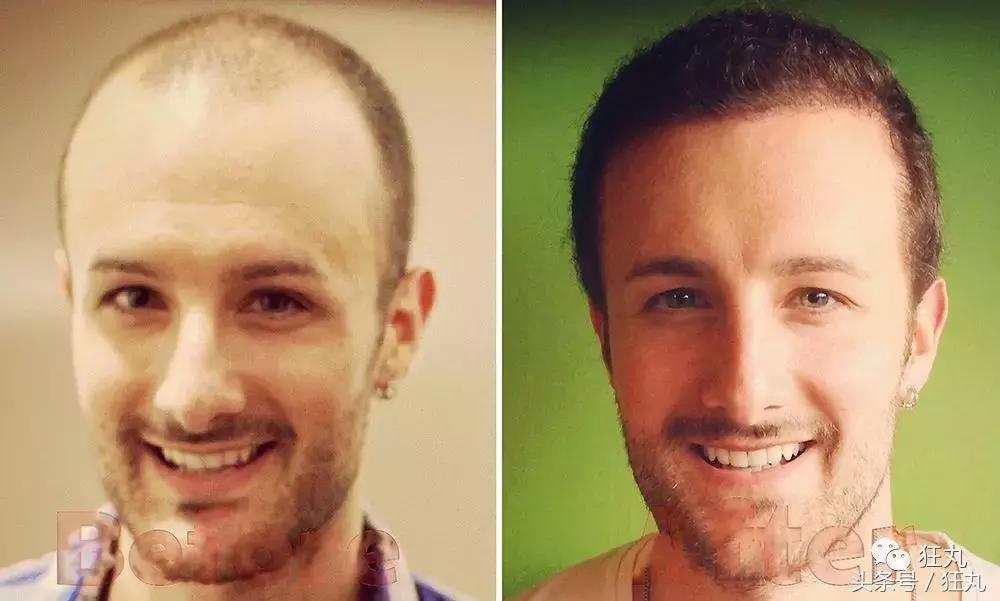 日本研究秃顶,日本教授秃头研究