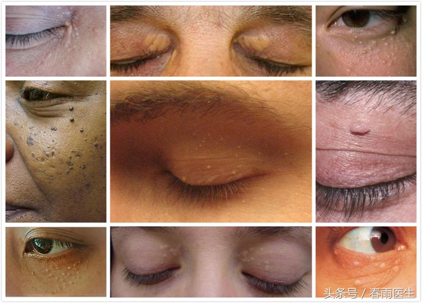眼睛周围长脂肪粒该怎么洗脸,眼睛周围长脂肪粒是什么原因